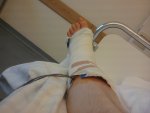Bein an Gips...