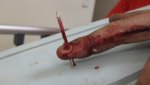 Nail-gun-injury-Hand-003-8-590x331.jpg