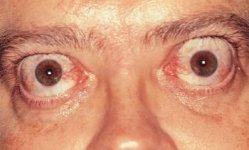 75_graves_disease_slide_22_springer_high-1_de.jpg