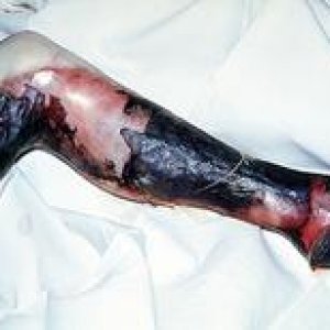 Medium 'Raucherbein' im Album 'Nichtraucher aus Überzeugung'